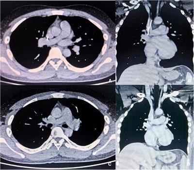 Case Report: Endoluminal removal of a conical retrievable superior vena cava filter with a retraction hook attached to the wall